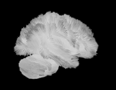 Autoimmune Encephalitis